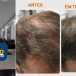 Em Suzano, marca MS Tricologia e Estética é reconhecida por tratamento moderno e eficaz contra a queda de cabelo