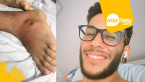 Jovem suzanense é diagnosticado com doença infecciosa grave e corre risco de amputação; ele realiza arrecadação solidária para cirurgia