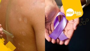 Janeiro Roxo: conscientização e combate à hanseníase; veja os cuidados Janeiro Roxo
